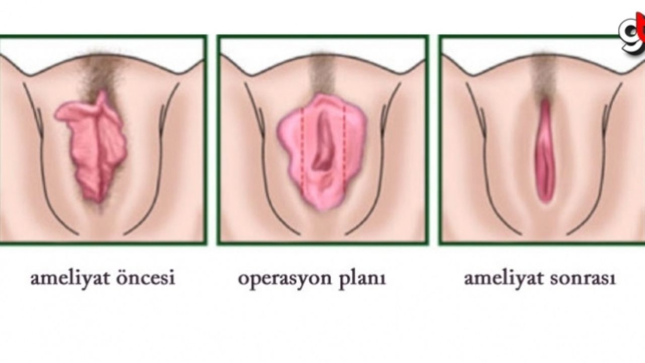 Genital Estetik (Vajinoplasti) nedir ? Kimlere Uygulanır ? Ameliyat nasıl geçer?
