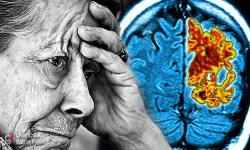 Basit Unutkanlık' ile Alzheimer unutkanlığı farklı