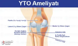 Yüksek Tibial Osteotomi (YTO): Dizde Yük Dağılımını Düzeltmenin Akıllı Yolu