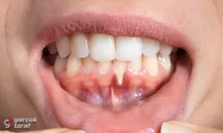 Diş eti çekilmesinin en büyük sebebi diş taşı!