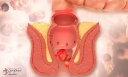 Hemoroid (Basur) Nedir, Neden Olur, Nasıl Geçer?