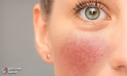 Soğuklarda cilt kuruluğuna karşı 10 tavsiye