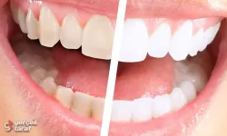 Diş beyazlatma nasıl yapılır? Evde diş beyazlatma yöntemleri var mı?