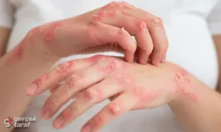 Vücudunuzdaki O Lekeler ve Uyuşmalar Cüzzam Habercisi Olabilir mi?