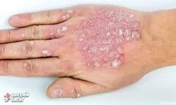 Sedef hastalığında hangi gıdalar faydalı hangi besinler zararlı