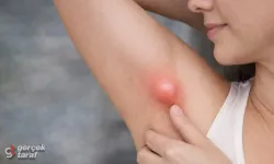 Koltuk Altındaki Şişlik Her Zaman Masum Değil: Ektopik Meme Dokusu Uyarısı