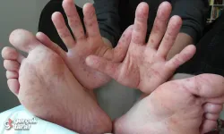 El ayak ağız hastalığında uzmandan 5 kritik uyarı