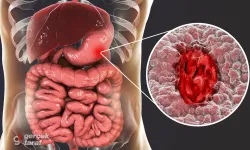 Endoskopi raporlarında geçen “pangastrit” nedir ne anlama geliyor?