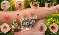 Yaz Aylarında Böcek Isırıkları Alarmı! Hangi Böcek Nasıl Isırır, Şişlik Ne Kadar Sürer, Ne Zaman Doktora Gidilmeli?