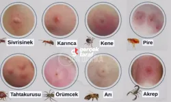 Böcek Isırıkları ve Belirtileri, Tedavi Yöntemleri