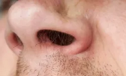 Burun Kıllarını Koparmak Menenjit Riskini Artırıyor!