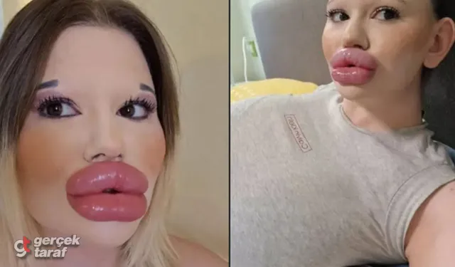 "Dünyanın En Büyük Dudaklı Kadını" Ölüme Meydan Okuyor: 33. Kez Bıçak Altına Yatacak