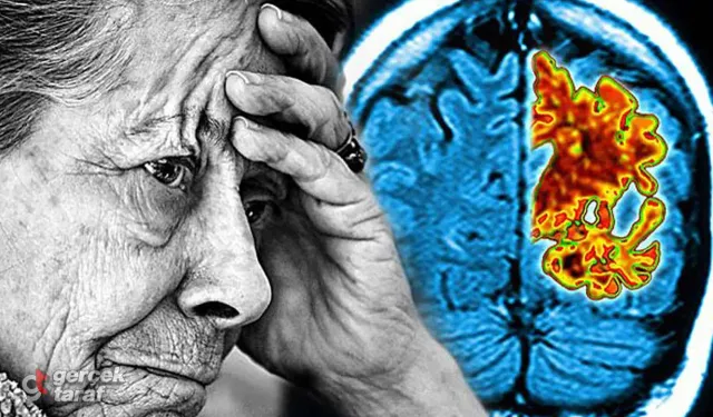 Basit Unutkanlık' ile Alzheimer unutkanlığı farklı