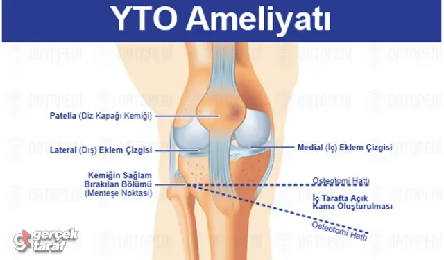 Yüksek Tibial Osteotomi (YTO): Dizde Yük Dağılımını Düzeltmenin Akıllı Yolu
