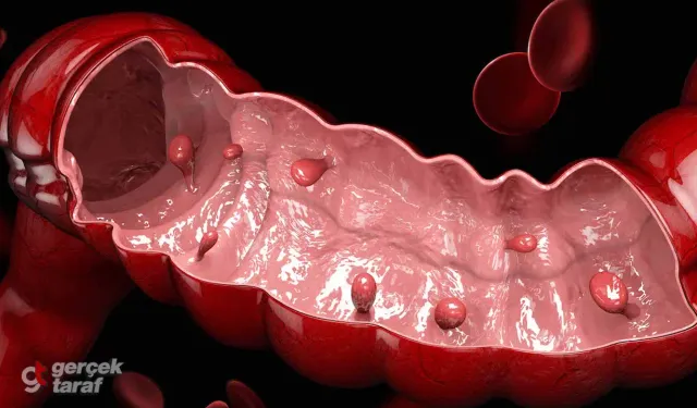 Gençlerde Kolon Polipi Sıklığı Artıyor! Düşük Lifli Beslenme ve Obezite Alarmı: Kolonoskopi Ne Zaman Yaptırılmalı?