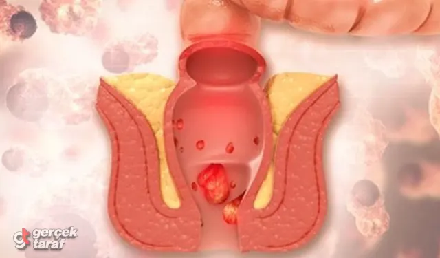 Hemoroid (Basur) Nedir, Neden Olur, Nasıl Geçer?