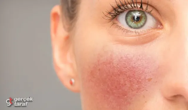Soğuklarda cilt kuruluğuna karşı 10 tavsiye