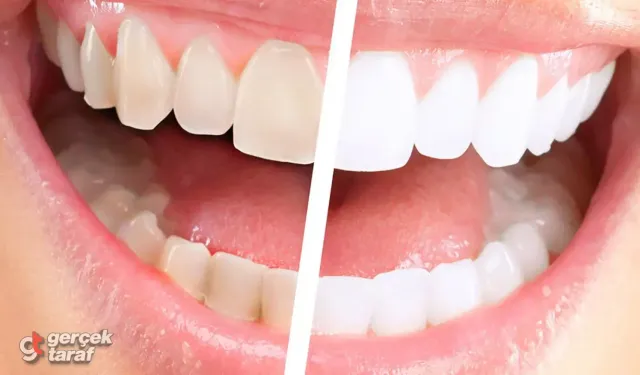 Diş beyazlatma nasıl yapılır? Evde diş beyazlatma yöntemleri var mı?