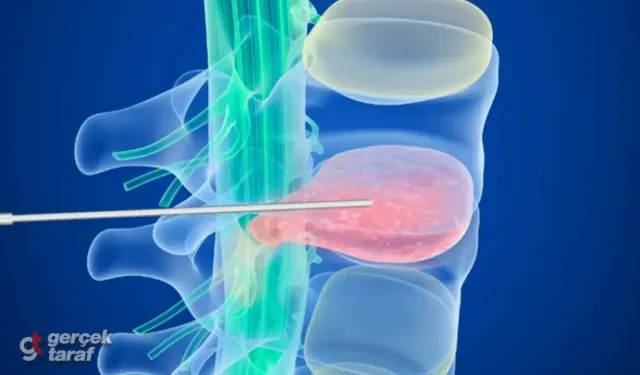 Hızlı İyileşme, Güçlü Etki: Nükleoplasti Tedavisi Nedir?