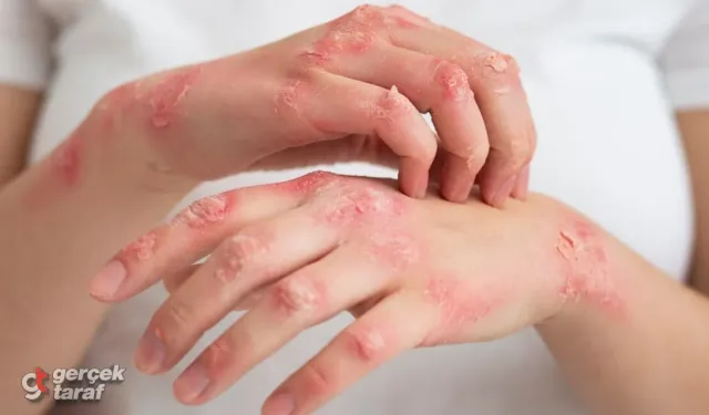 Vücudunuzdaki O Lekeler ve Uyuşmalar Cüzzam Habercisi Olabilir mi?