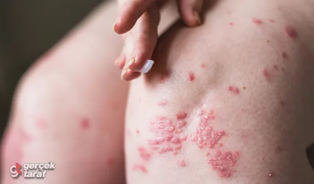 Zona Tedavisi Hakkında Doğru Bİlinen Yanlışlar