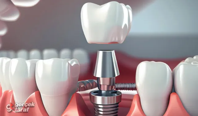 Tek Diş İmplant Uygulaması Nasıl Yapılır?