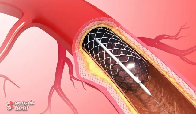 Korkulan Değil, Anlaşılan İşlem: Stent Nasıl Takılır?