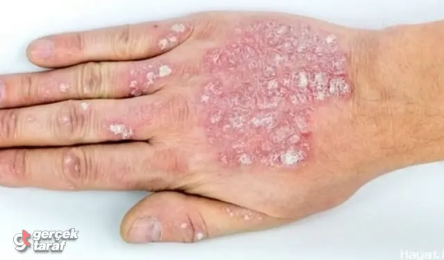 Sedef hastalığında hangi gıdalar faydalı hangi besinler zararlı