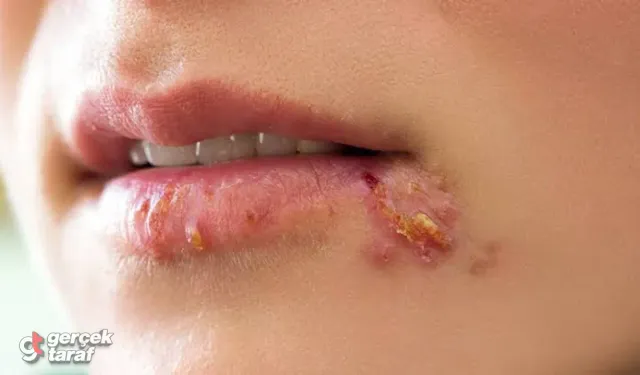Dudak Kenarı Çatlakları Yara İçin Hangi Krem Kullanılmalı? Evde Doğal Yöntemler İşe Yarar mı Tedavisi Nasıl?