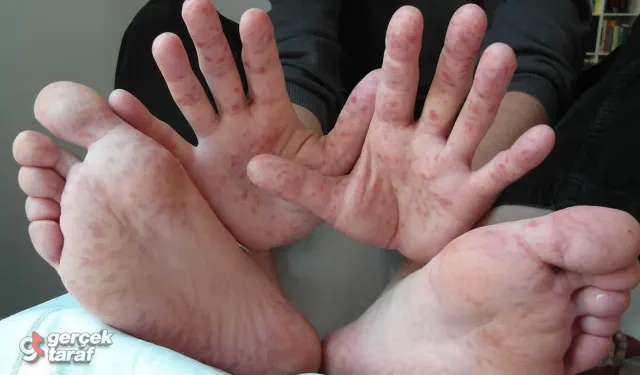El ayak ağız hastalığında uzmandan 5 kritik uyarı
