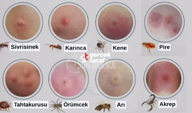 Böcek Isırıkları ve Belirtileri, Tedavi Yöntemleri