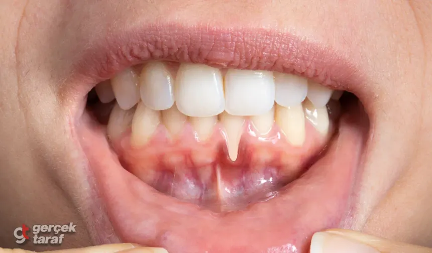 Diş eti çekilmesinin en büyük sebebi diş taşı!