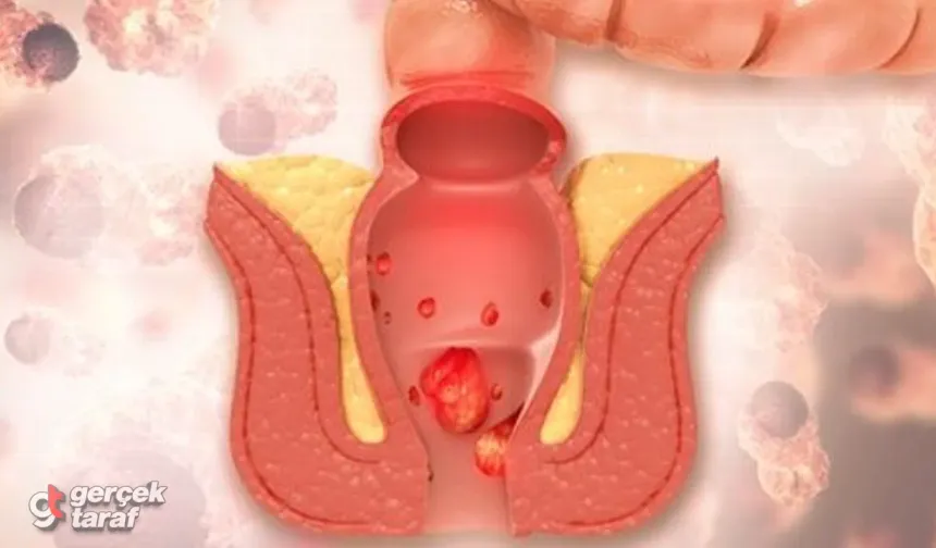 Hemoroid (Basur) Nedir, Neden Olur, Nasıl Geçer?