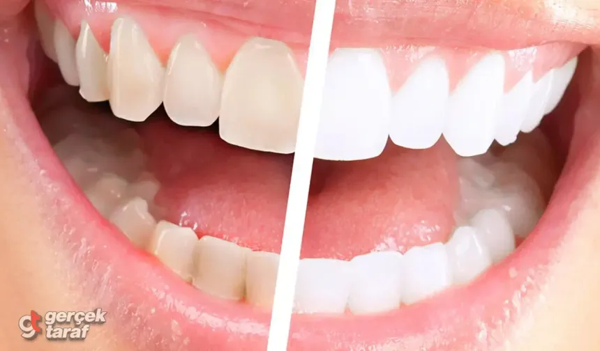 Diş beyazlatma nasıl yapılır? Evde diş beyazlatma yöntemleri var mı?