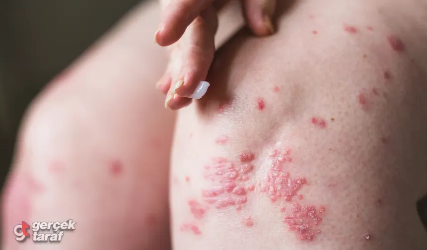 Zona Tedavisi Hakkında Doğru Bİlinen Yanlışlar