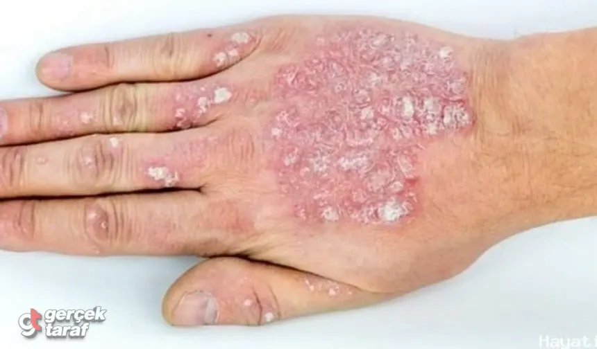 Sedef hastalığında hangi gıdalar faydalı hangi besinler zararlı