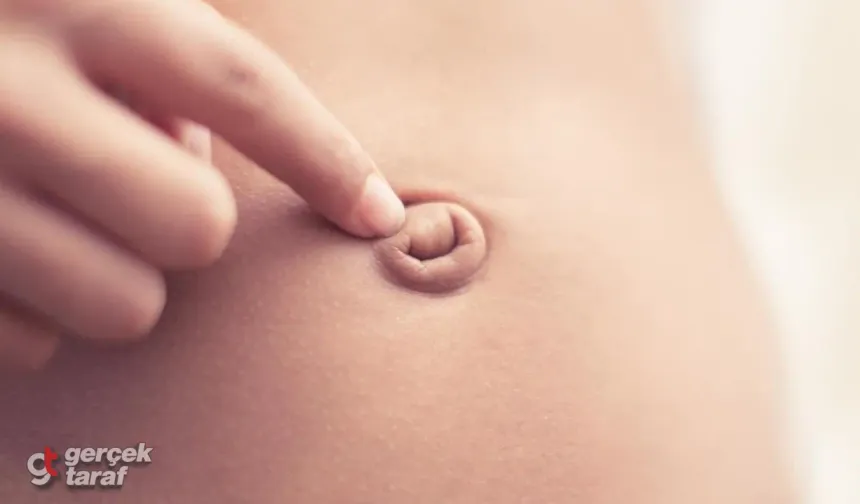 Göbek Fıtığı Nedir? Belirtileri, Nedenleri ve Tedavi Süreci