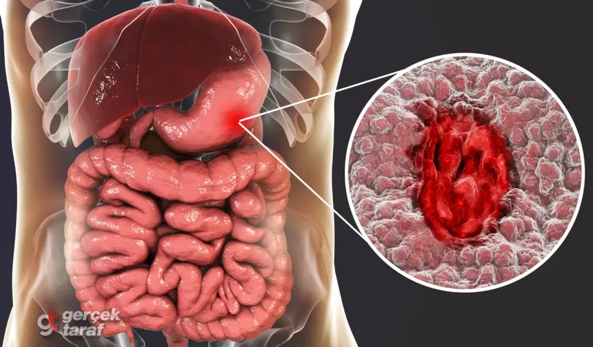 Endoskopi raporlarında geçen “pangastrit” nedir ne anlama geliyor?
