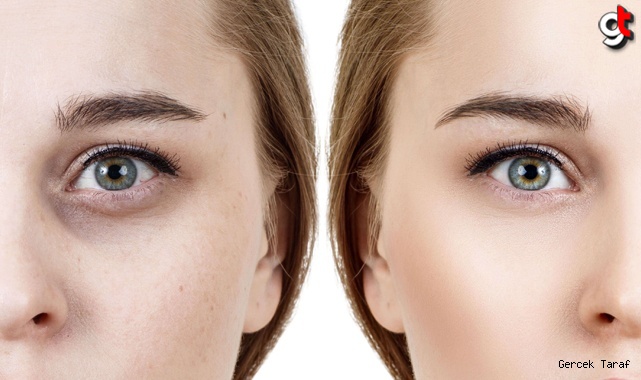 Göz altı morlukları için ne yapmak gerekir?