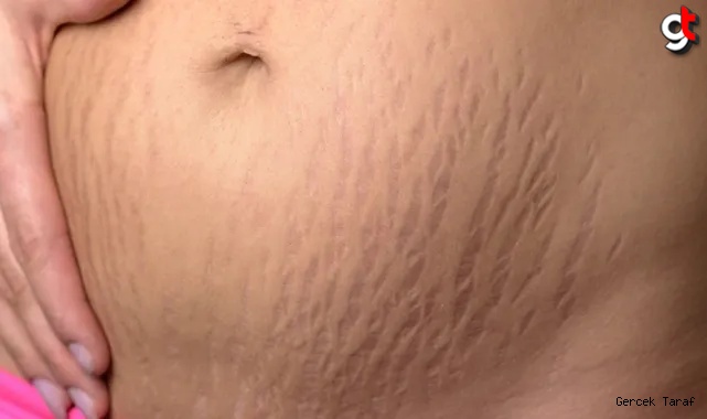 Hamilelik çatları neden olur, nasıl geçer tedavisi